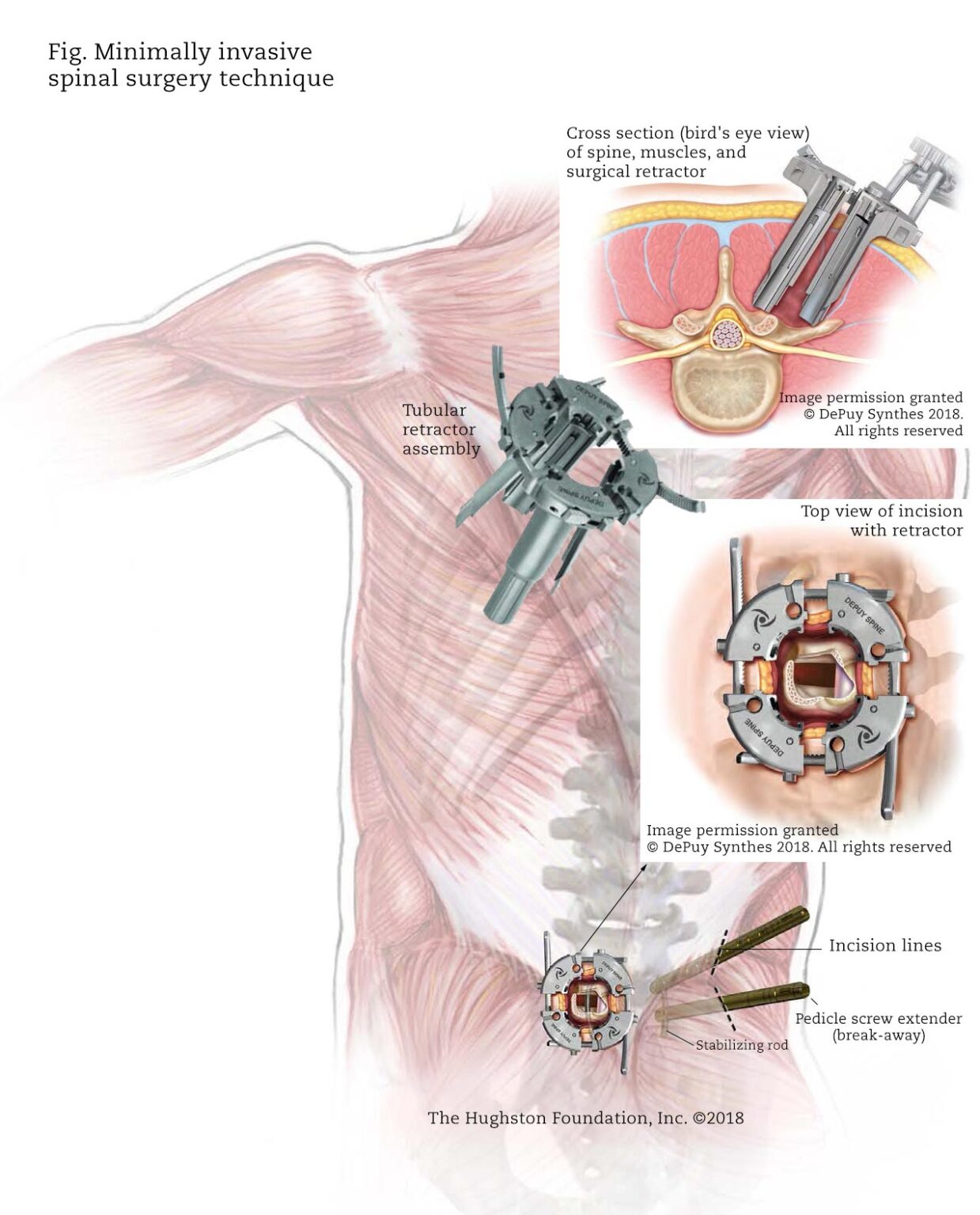 Minimally Invasive Spinal Surgery At A Glance Alabama