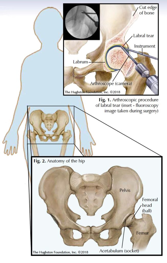 Hip Arthroscopy Alabama