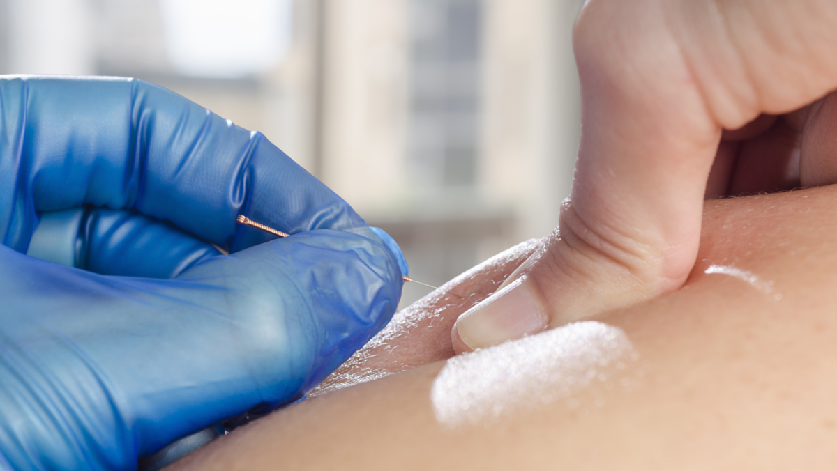 Dry Needling: What You Should Know