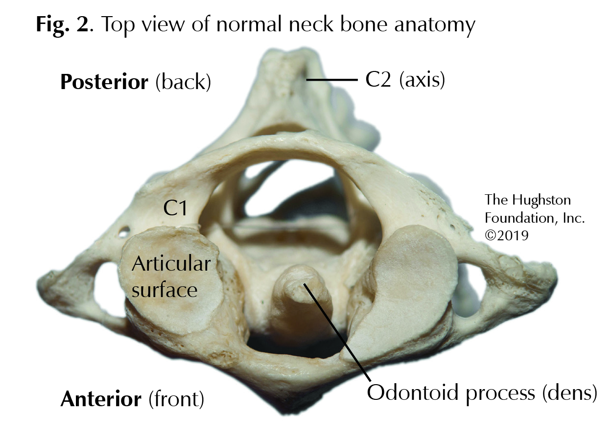 Odontoid Fractures Alabama 9250