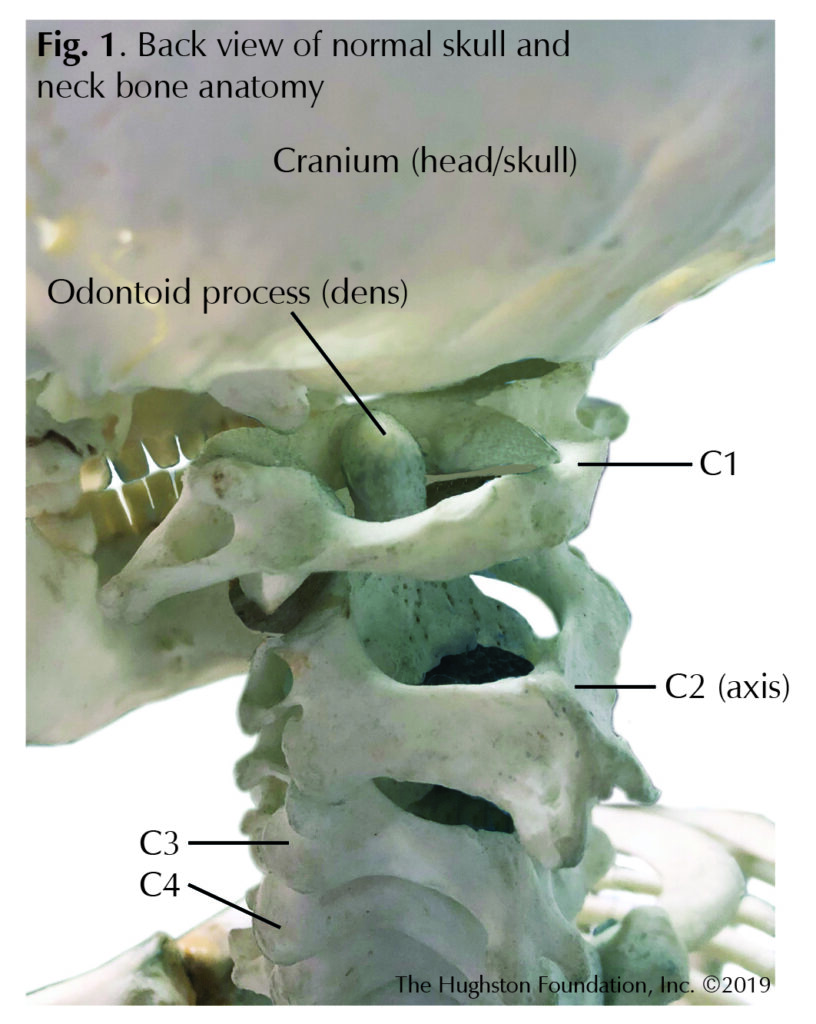 Odontoid Fractures Alabama