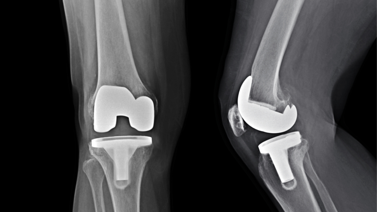 Total Knee Arthroplasty: Questions for a Specialist