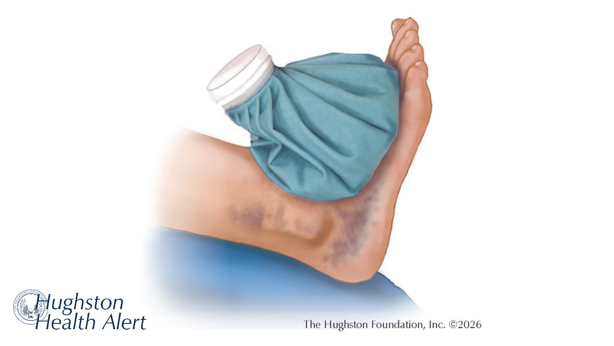 Ankle Sprains